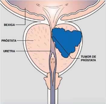 O câncer de próstata pode se espalhar para outros órgãos?