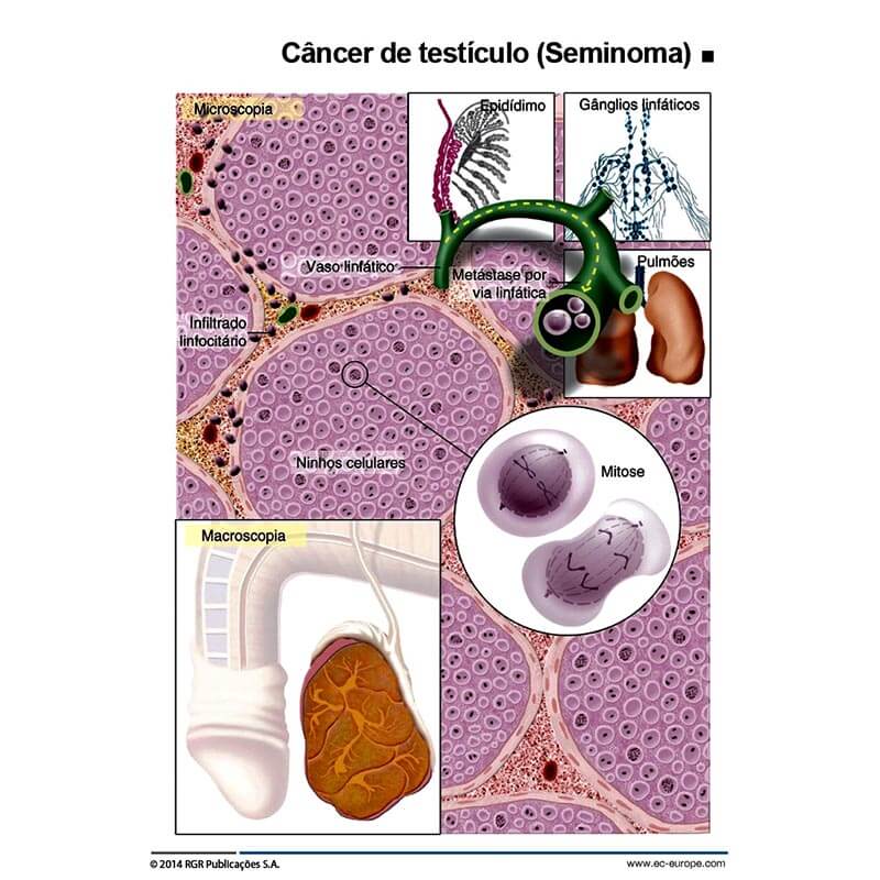 cancer testiculo seminoma