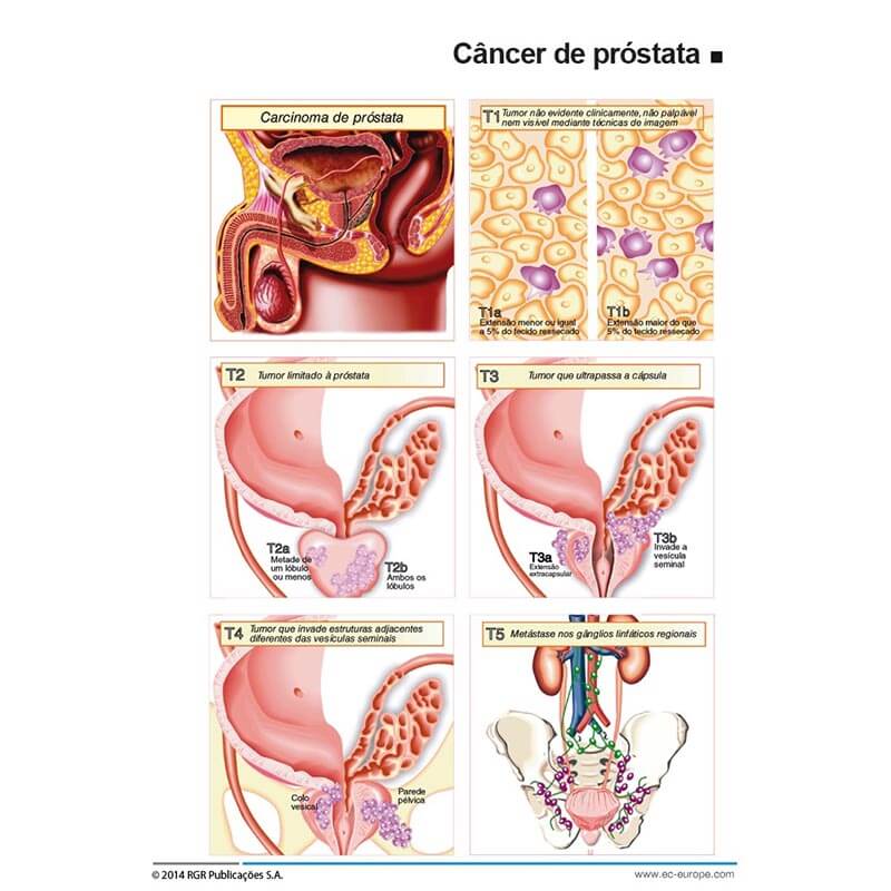 adenocarcinoma prostata tratamento