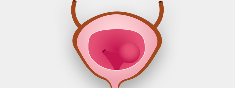 O que é ureterocele?